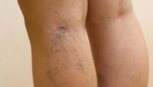 Síntomas das varices nas mulleres